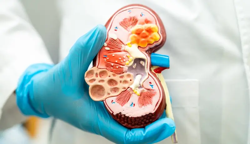 Close-up of a gloved hand holding a kidney model showing anatomical details, including renal structures and potential blockages.