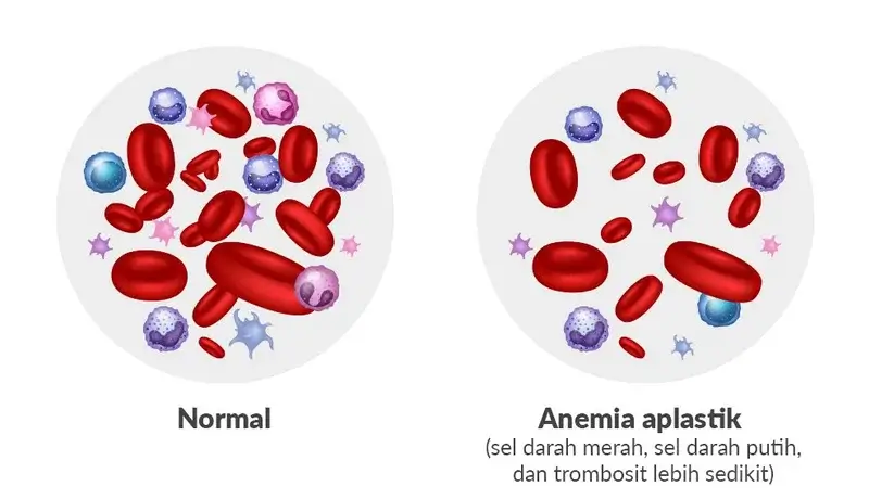 The explanation of aplastic anemia
