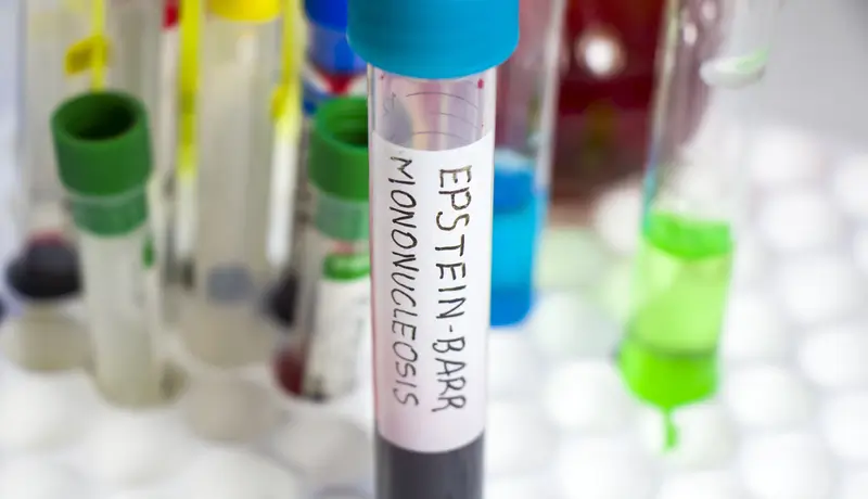 Σωληνάριο αίματος με ετικέτα "Epstein-Barr Mononucleosis" τοποθετημένο σε ιατρικό εργαστηριακό περιβάλλον.