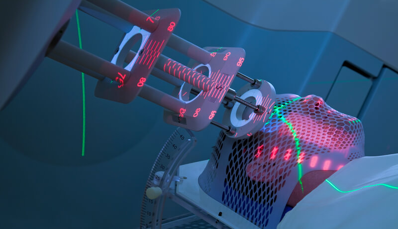 Radiation therapy neurological damage