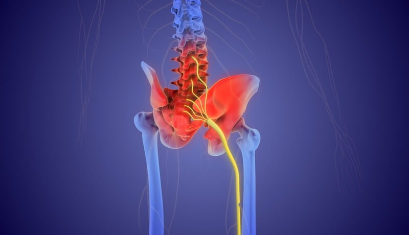 Sciatica Causes and Treatment