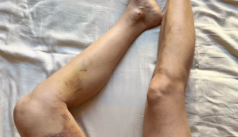 A photo showing the legs of a person, with one leg visibly bruised and swollen, likely due to a femoral fracture or severe injury.