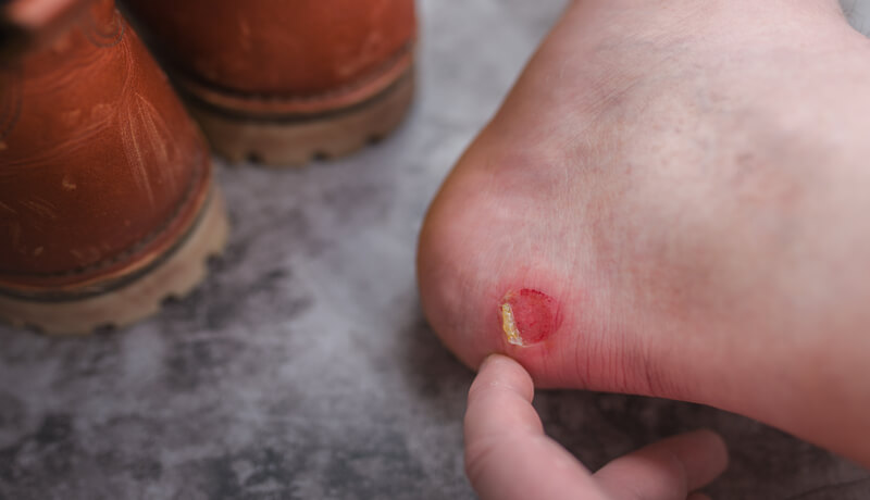 A rubbed blister on the heel of the foot
