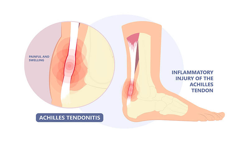 Achilles tendonitis treatment Αντιμετώπιση τενοντίτιδας Αχίλλειου