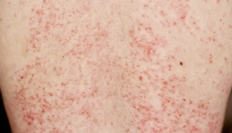 Allergic rash on skin. Woman with dermatology problem on back skin