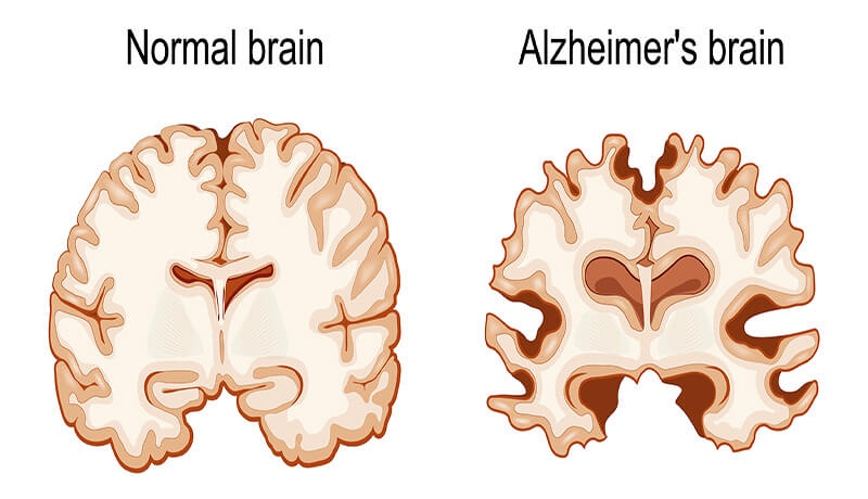 Alzheimer's Disease Early Diagnosis Έγκαιρη Διάγνωση Νόσου Αλτσχάιμερ