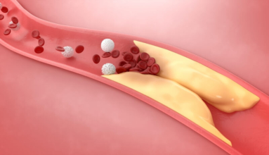 Thrombosis serious health threat
Μια εικόνα που δέιχνει αναλυτικά την θρόμβωση