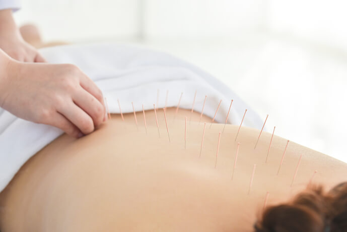 Benefits of Acupuncture Therapy