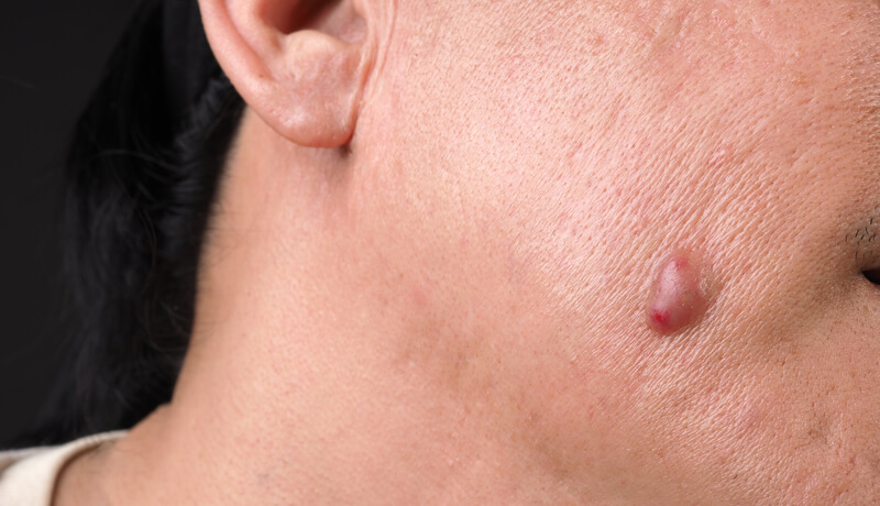 Big Acne Cyst Abscess or Ulcer Swollen area within face skin tissue.