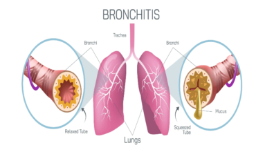 a picture showing how bronchis symptoms work when they are open or clogged