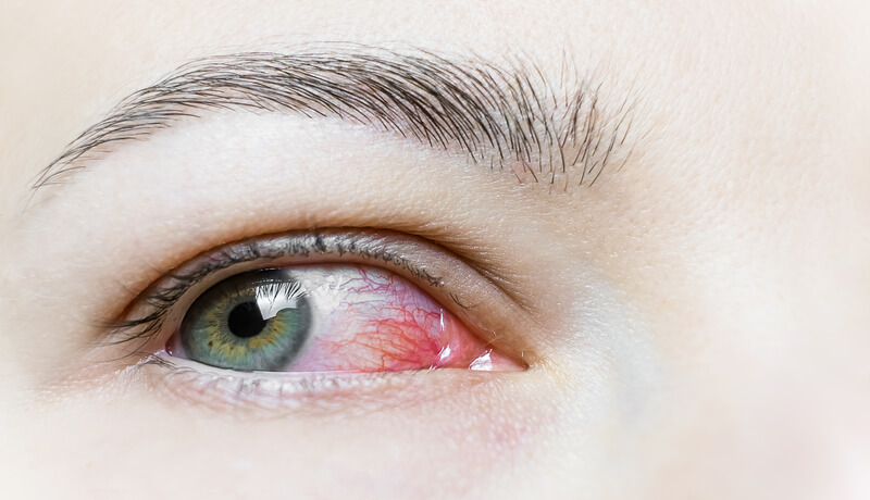 Close up of a severe bloodshot red eye. Viral Blepharitis, Conjunctivitis, Adenoviruses. Irritated