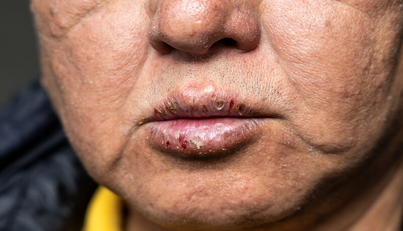 Closeup of elderly Asian man with dry face and chapped cracked lips with dryness 