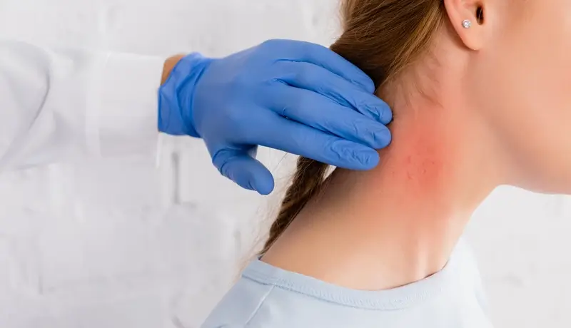 Cropped view of doctor in latex glove touching neck of woman with allergy reaction