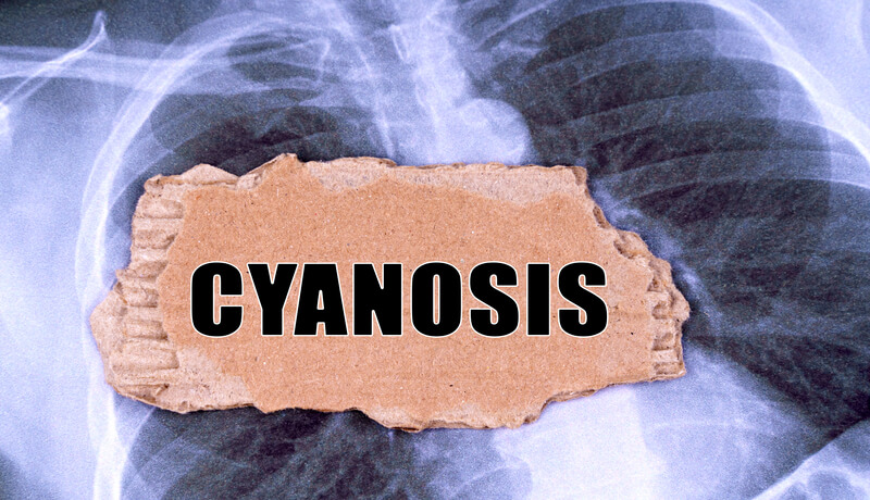 Cyanosis in children