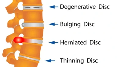 anatomy picture showing compressed and noraml disks