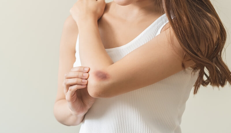 Easy bruising disorders