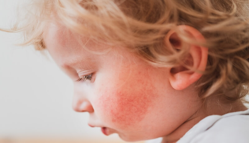 A baby with scarlet fever