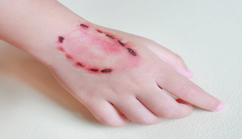 Human Bite Treatment