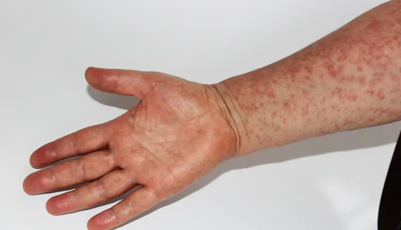 A picture that shows a hand with measles