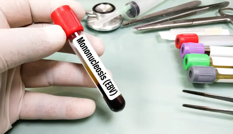 A picture that shows examinations of mononucleosis