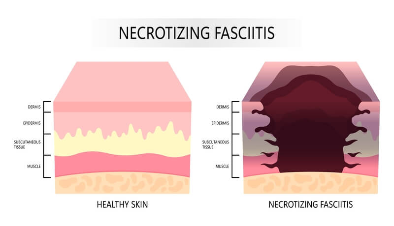 Necrotizing skin infection treatment Θεραπεία νεκρωτικών δερματικών λοιμώξεων