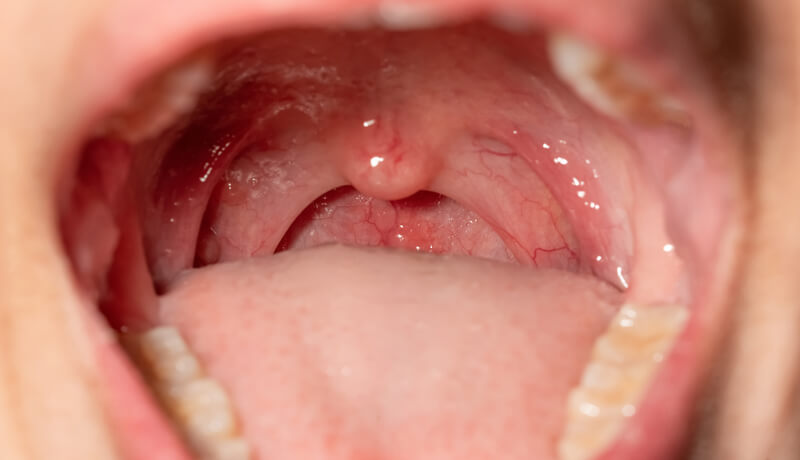 Sore throat with throat swollen. Closeup open mouth with posterior pharyngeal wall swelling