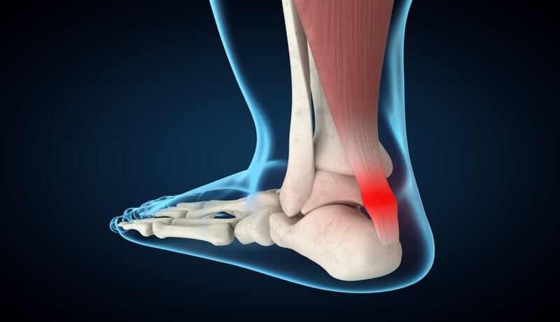 A picture that shows an injured achilles Achilles Tendinitis Treatment