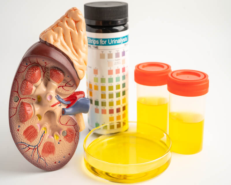 Kidney model alongside urine samples and a urine analysis strip, highlighting diagnostic tools for kidney and urinary conditions.