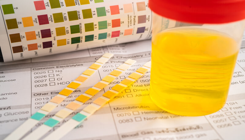 Urinalysis, urine cup with reagent strip pH paper test and comparison chart in laboratory.