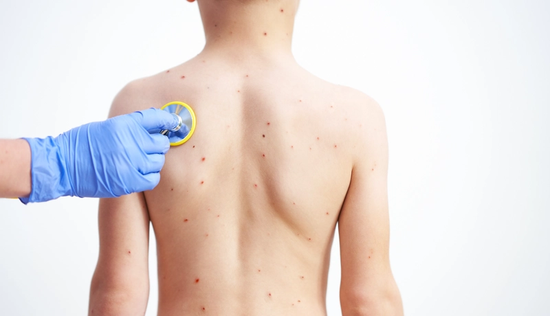 Young boy having chickenpox pictures of skin